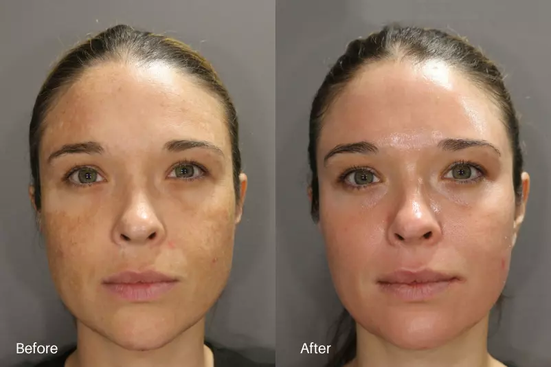 Melasma before and after treatment result