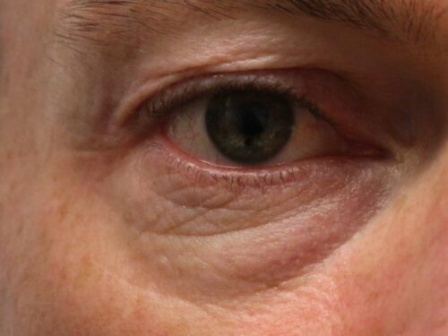 Eye Rejuvenation (1) before