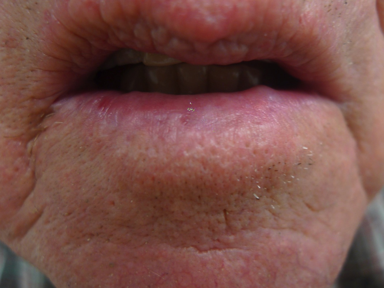 Lip, Skin Cancer, Ablative Laser