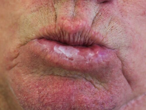 Lip, Skin Cancer, Ablative Laser