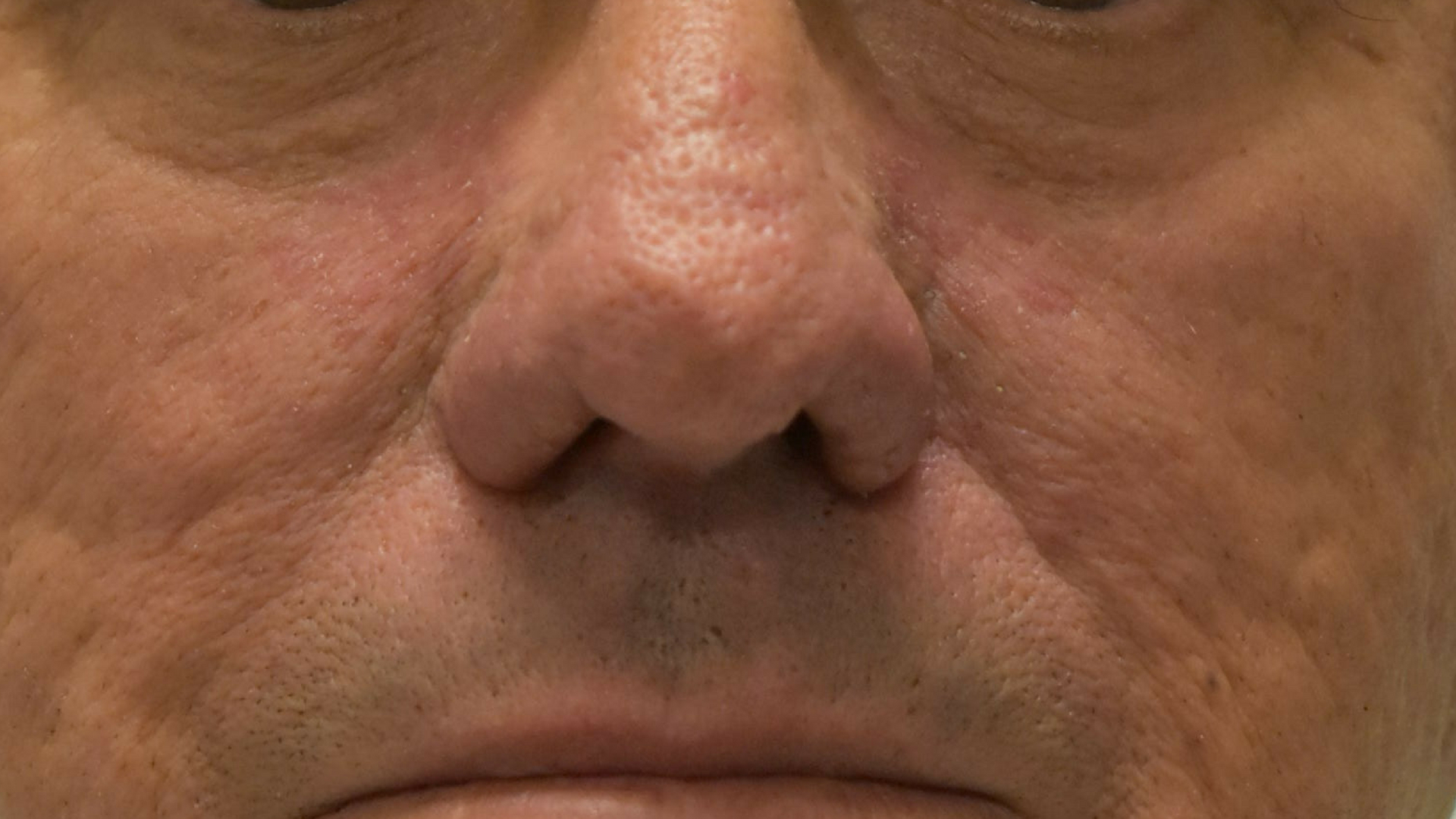 Rhinophyma Brisbane Skin after image