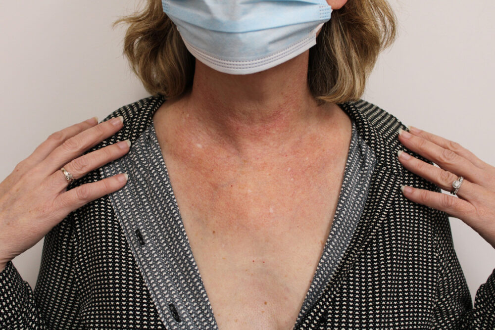 Sun Damage (2) | Brisbane Skin