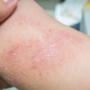 Patch Testing | Brisbane Skin