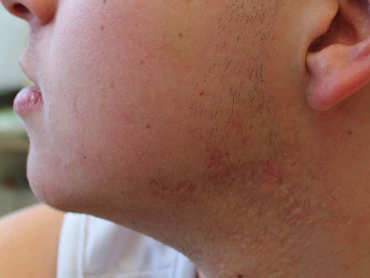 acne after