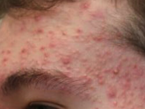 acne before